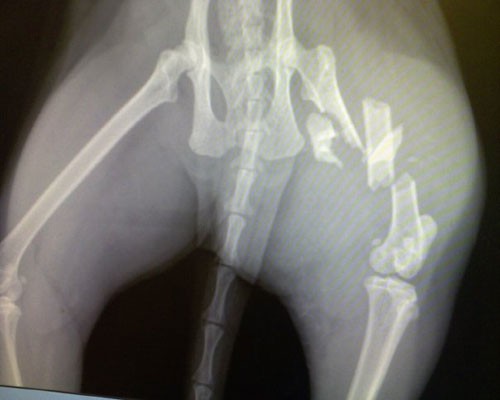 Comminuted fracture Comminuted fracture